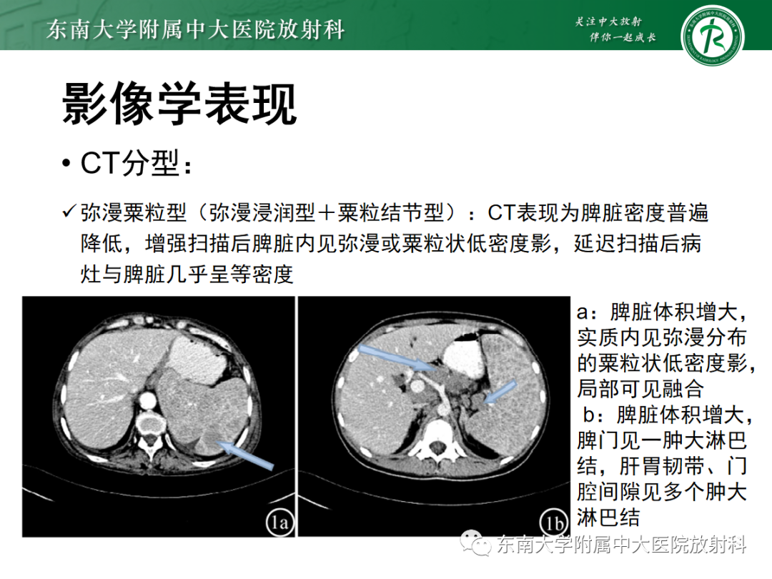 影像PPT - 【PPT】脾脏硬化性血管瘤样结节性转化-29
