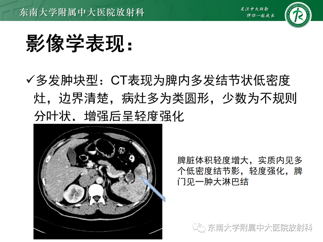影像PPT - 【PPT】脾脏硬化性血管瘤样结节性转化-30
