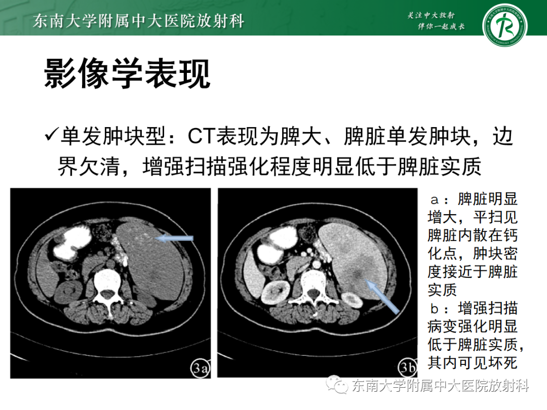 影像PPT - 【PPT】脾脏硬化性血管瘤样结节性转化-31