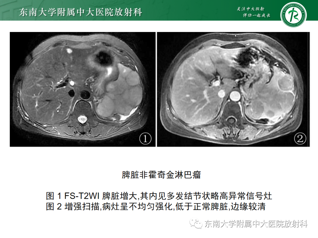 影像PPT - 【PPT】脾脏硬化性血管瘤样结节性转化-33