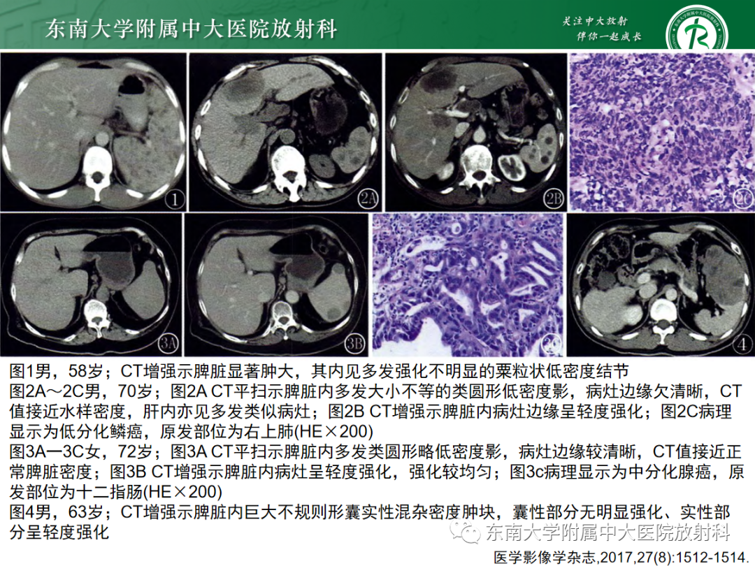 影像PPT - 【PPT】脾脏硬化性血管瘤样结节性转化-36