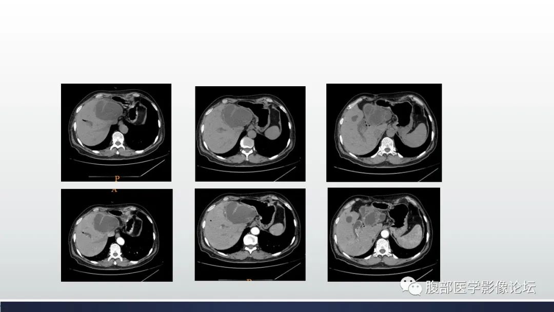 影像PPT - 【病例】肝脏交界性粘液性囊腺瘤1例CT及MR影像-3