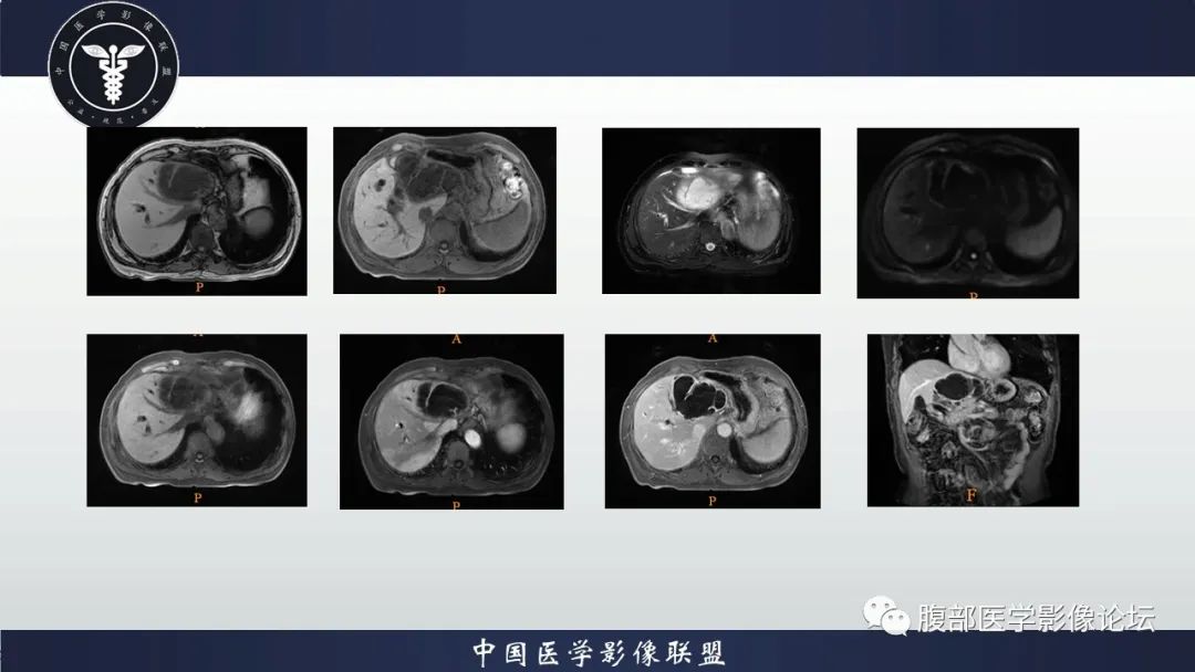 影像PPT - 【病例】肝脏交界性粘液性囊腺瘤1例CT及MR影像-4