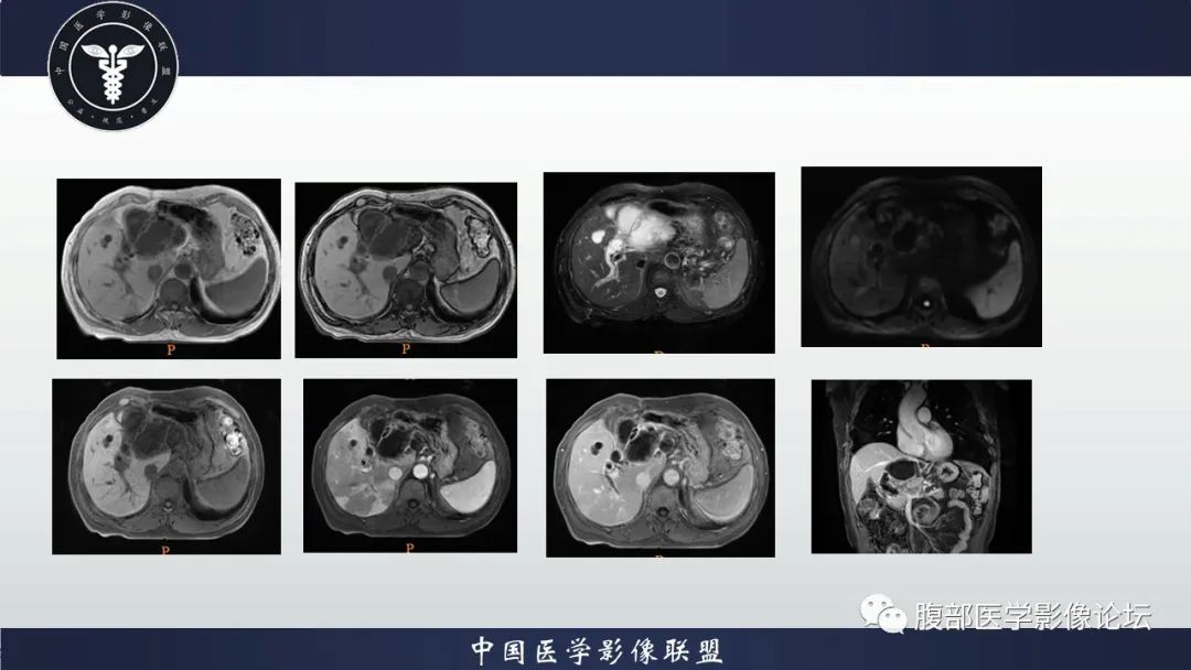 影像PPT - 【病例】肝脏交界性粘液性囊腺瘤1例CT及MR影像-5