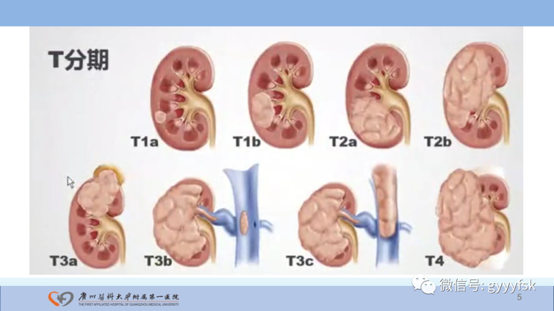 影像PPT - 【PPT】肾癌相关影像诊断的文献汇报-5