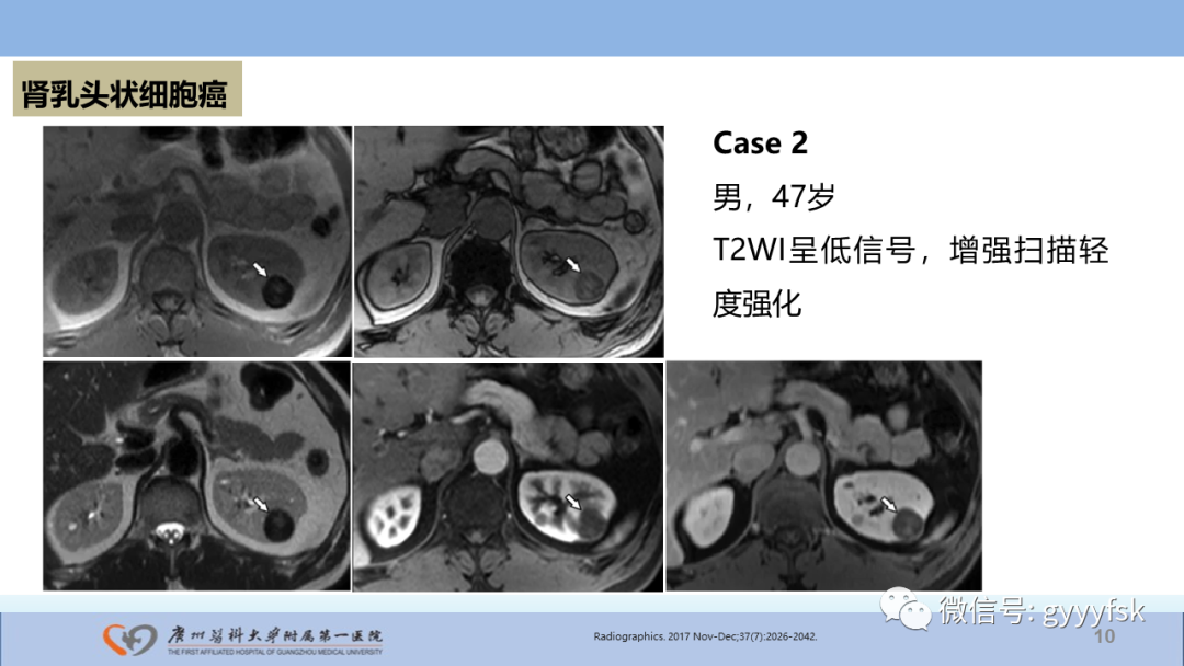影像PPT - 【PPT】肾癌相关影像诊断的文献汇报-10