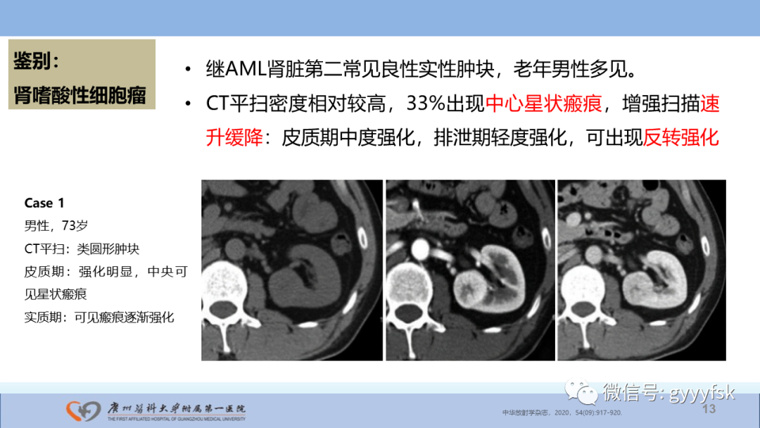 影像PPT - 【PPT】肾癌相关影像诊断的文献汇报-13