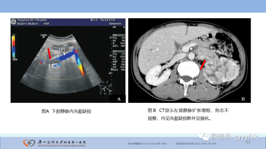 影像PPT - 【PPT】肾癌相关影像诊断的文献汇报-17