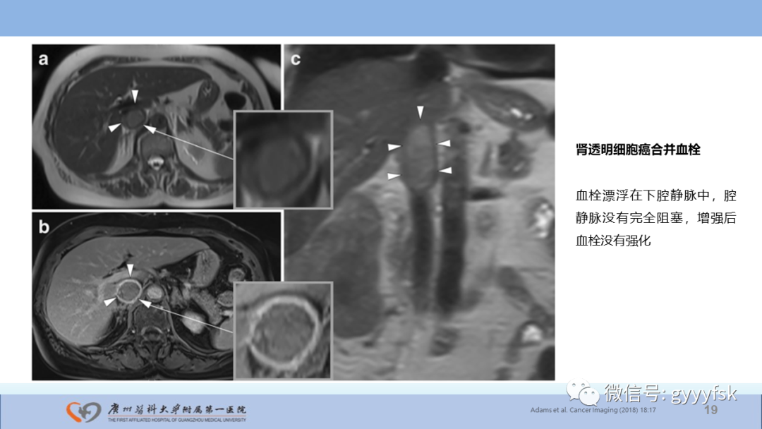 影像PPT - 【PPT】肾癌相关影像诊断的文献汇报-19
