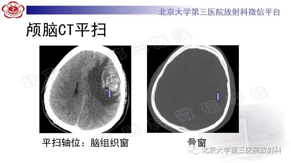 影像PPT - 【PPT】间变性脑膜瘤-3