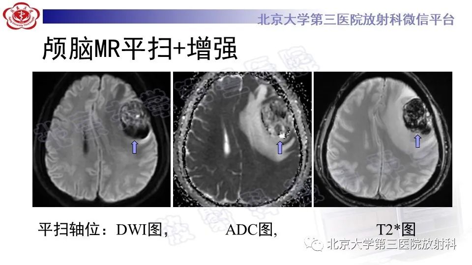 影像PPT - 【PPT】间变性脑膜瘤-5