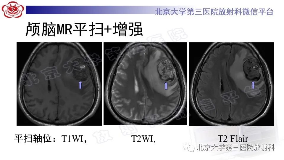 影像PPT - 【PPT】间变性脑膜瘤-4
