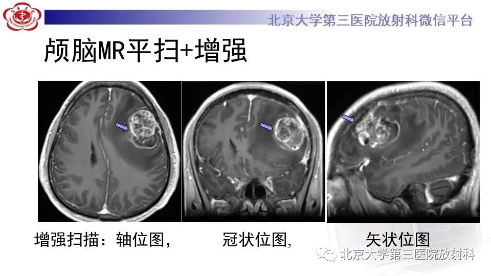 影像PPT - 【PPT】间变性脑膜瘤-6