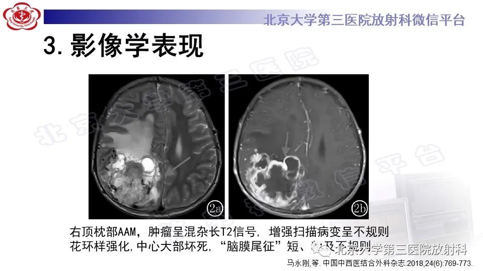 影像PPT - 【PPT】间变性脑膜瘤-18