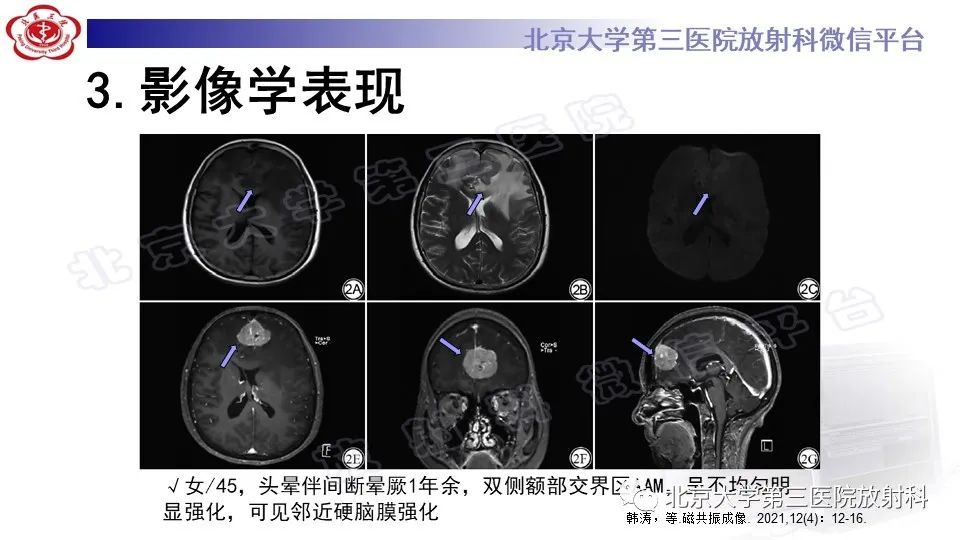 影像PPT - 【PPT】间变性脑膜瘤-19