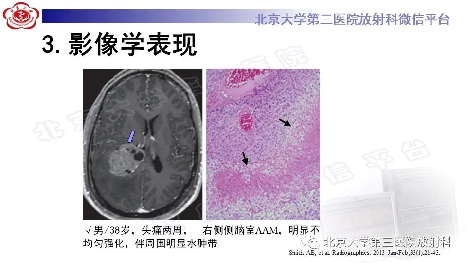 影像PPT - 【PPT】间变性脑膜瘤-20