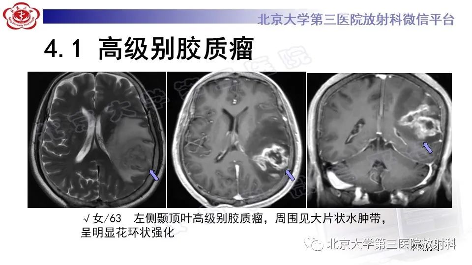 影像PPT - 【PPT】间变性脑膜瘤-23