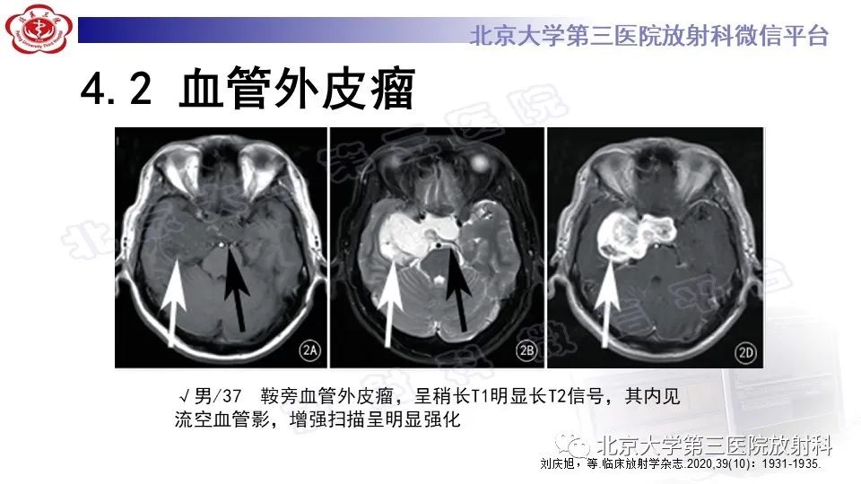 影像PPT - 【PPT】间变性脑膜瘤-25
