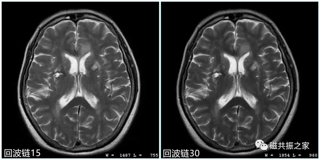 影像PPT - MRI参数优化中的回波链-12 影像PPT - MRI参数优化中的回波链-12