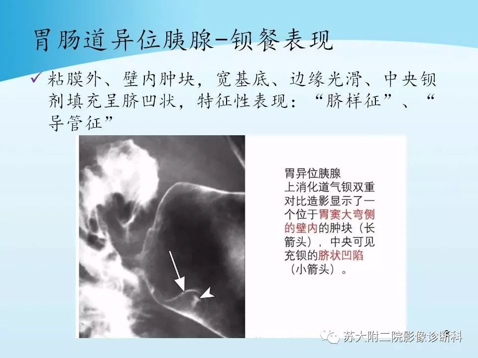 影像PPT - 【PPT】异位胰腺影像学特征及并发症-8
