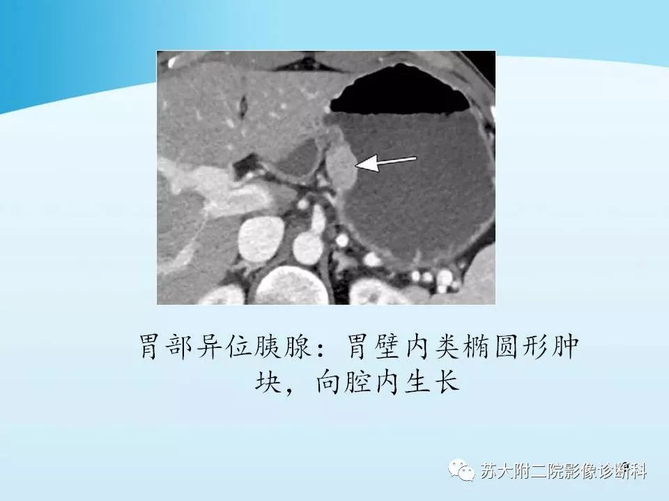 影像PPT - 【PPT】异位胰腺影像学特征及并发症-9