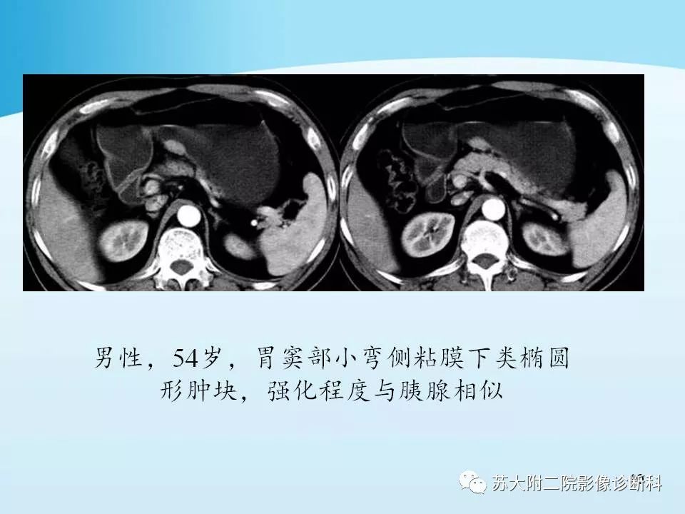 影像PPT - 【PPT】异位胰腺影像学特征及并发症-10