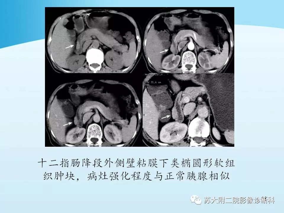 影像PPT - 【PPT】异位胰腺影像学特征及并发症-11