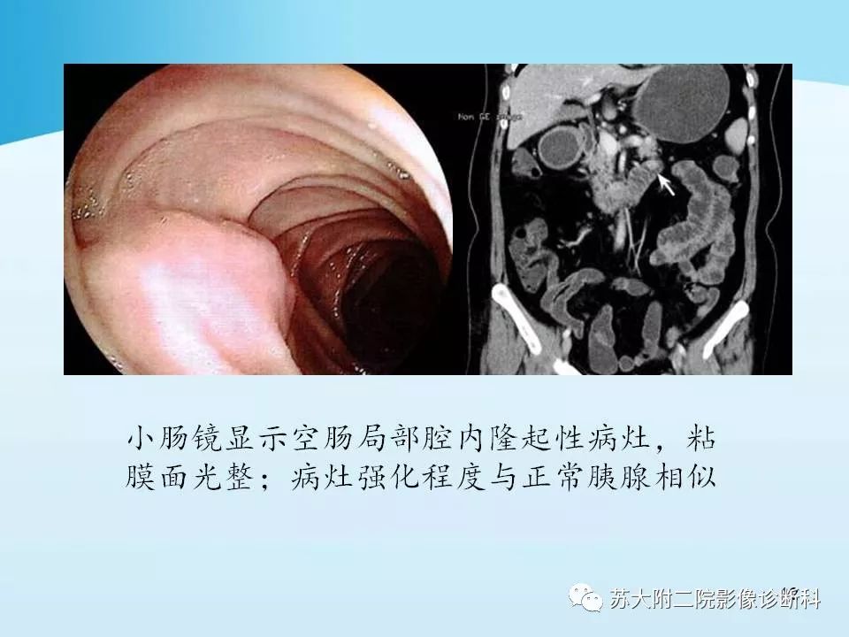 影像PPT - 【PPT】异位胰腺影像学特征及并发症-12