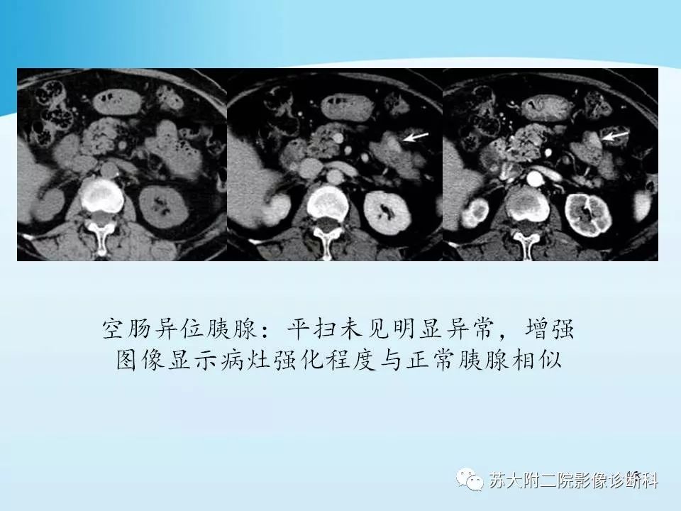 影像PPT - 【PPT】异位胰腺影像学特征及并发症-13