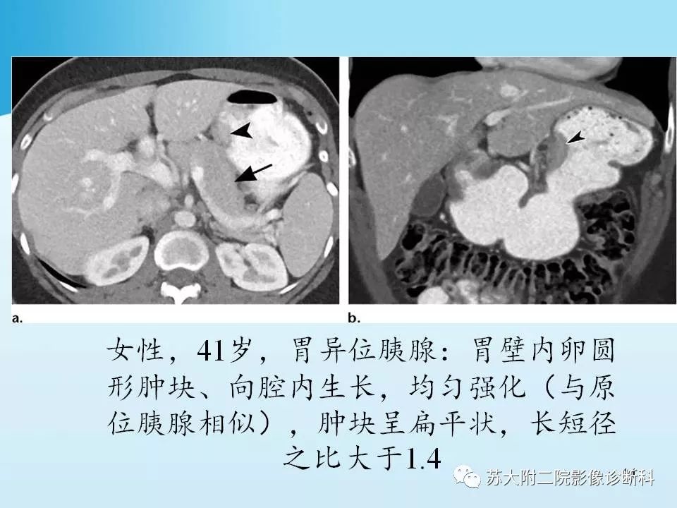 影像PPT - 【PPT】异位胰腺影像学特征及并发症-14