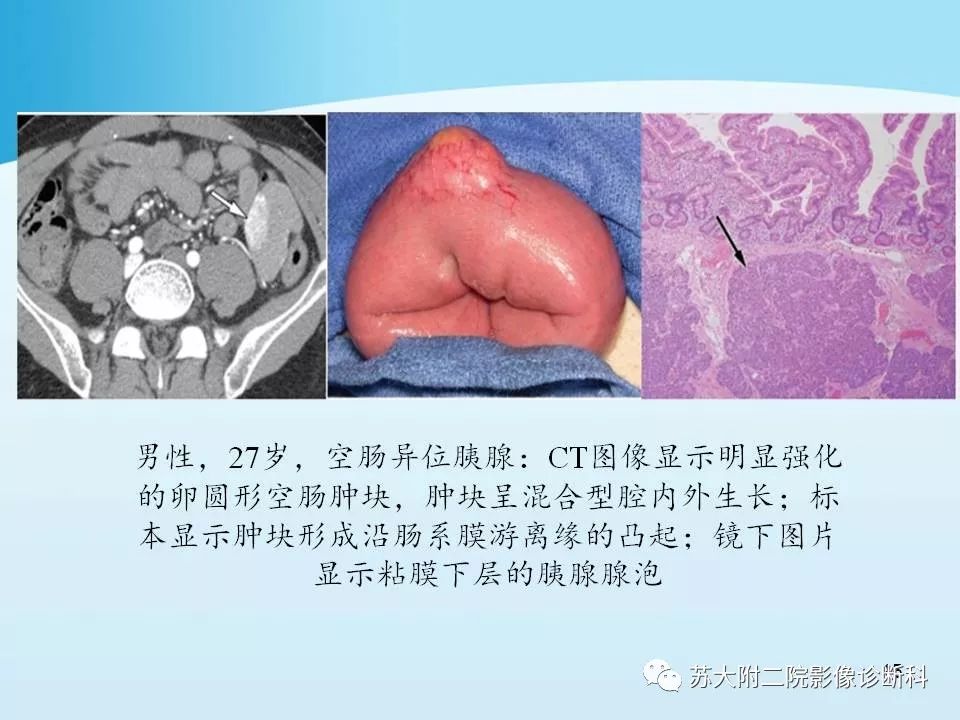 影像PPT - 【PPT】异位胰腺影像学特征及并发症-15