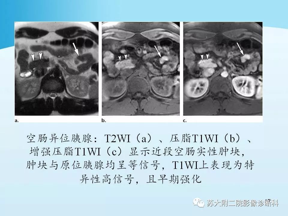影像PPT - 【PPT】异位胰腺影像学特征及并发症-17