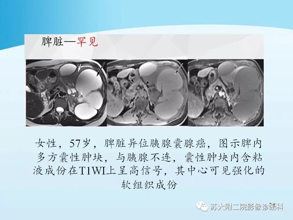 影像PPT - 【PPT】异位胰腺影像学特征及并发症-20