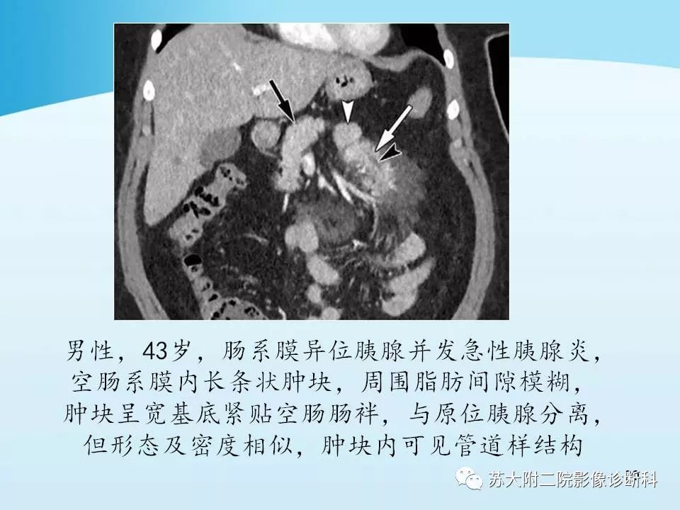影像PPT - 【PPT】异位胰腺影像学特征及并发症-19