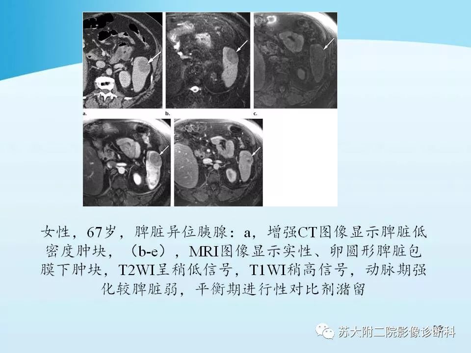影像PPT - 【PPT】异位胰腺影像学特征及并发症-21