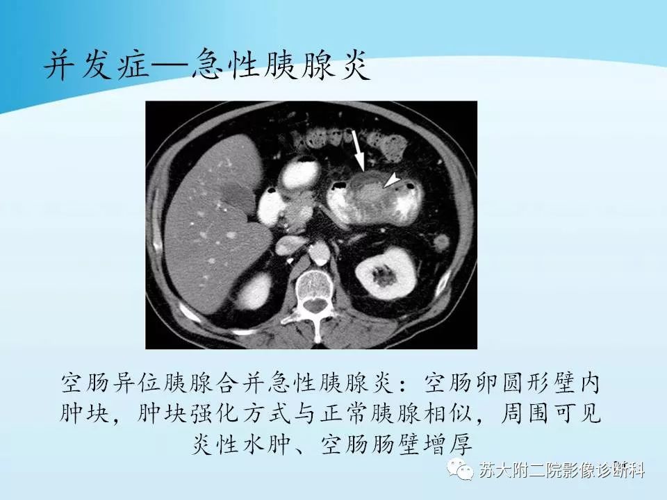 影像PPT - 【PPT】异位胰腺影像学特征及并发症-23