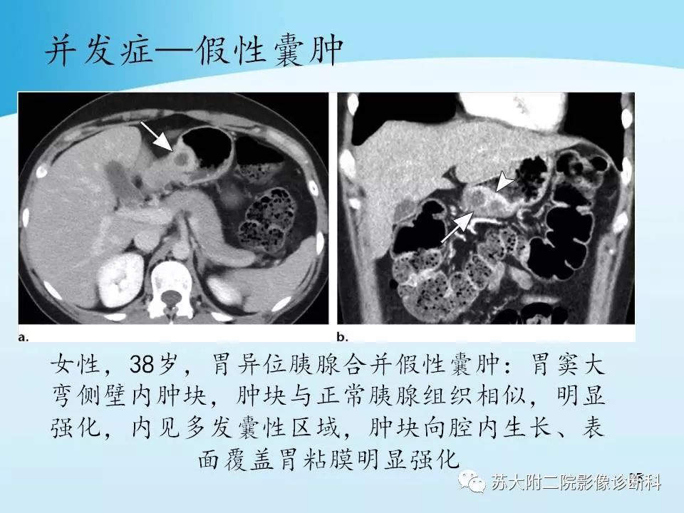 影像PPT - 【PPT】异位胰腺影像学特征及并发症-24