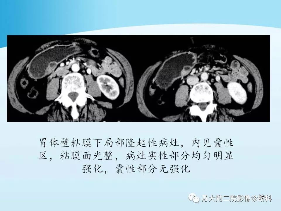 影像PPT - 【PPT】异位胰腺影像学特征及并发症-25