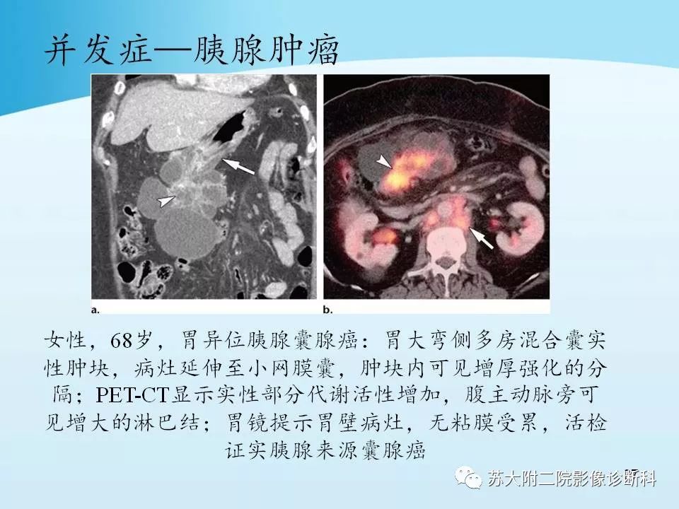 影像PPT - 【PPT】异位胰腺影像学特征及并发症-26