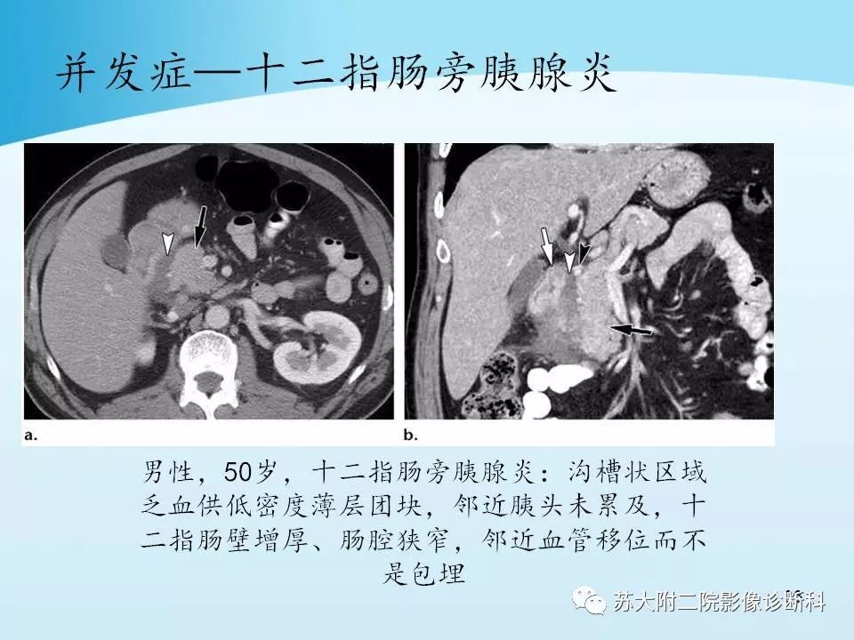 影像PPT - 【PPT】异位胰腺影像学特征及并发症-32