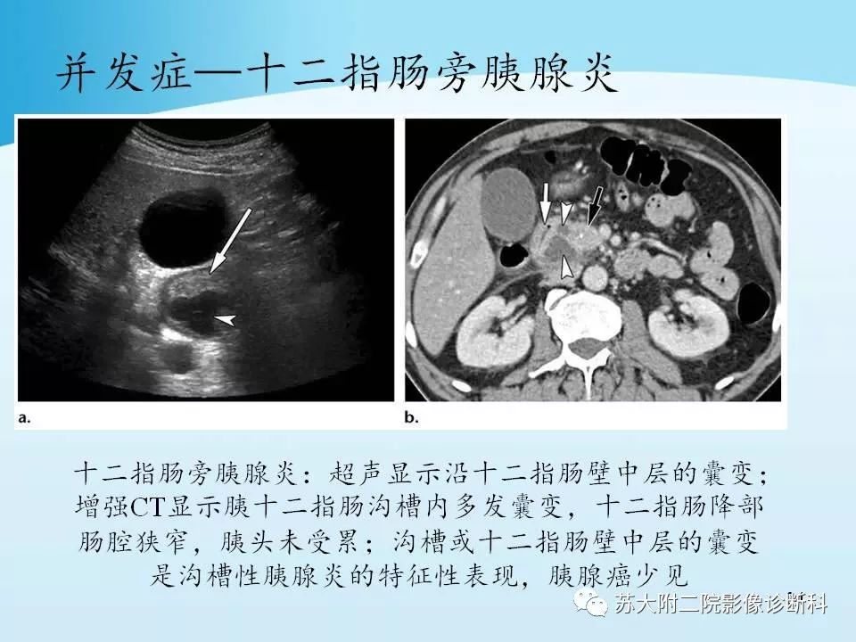 影像PPT - 【PPT】异位胰腺影像学特征及并发症-33