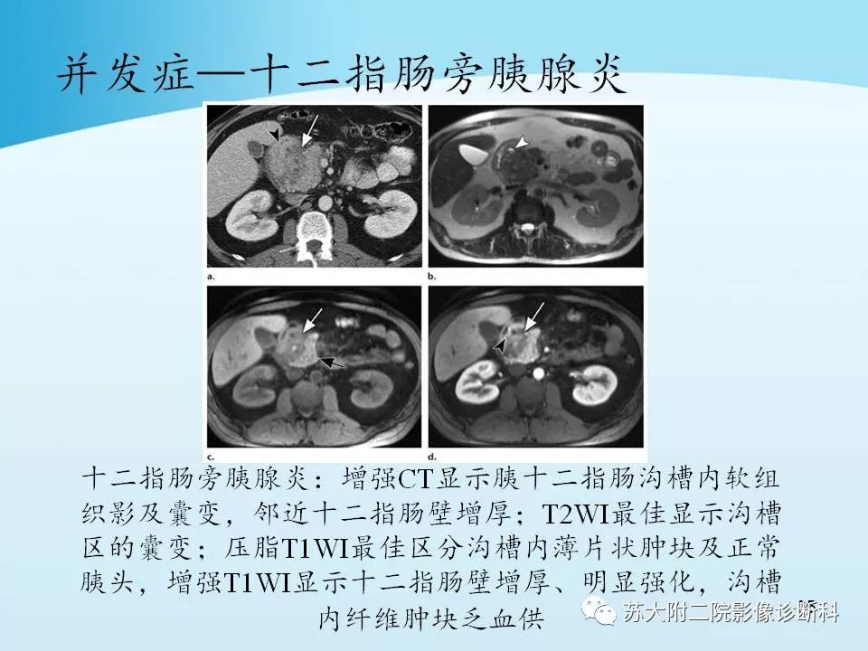 影像PPT - 【PPT】异位胰腺影像学特征及并发症-34