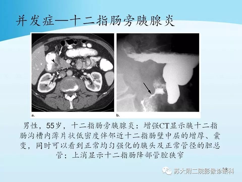 影像PPT - 【PPT】异位胰腺影像学特征及并发症-35