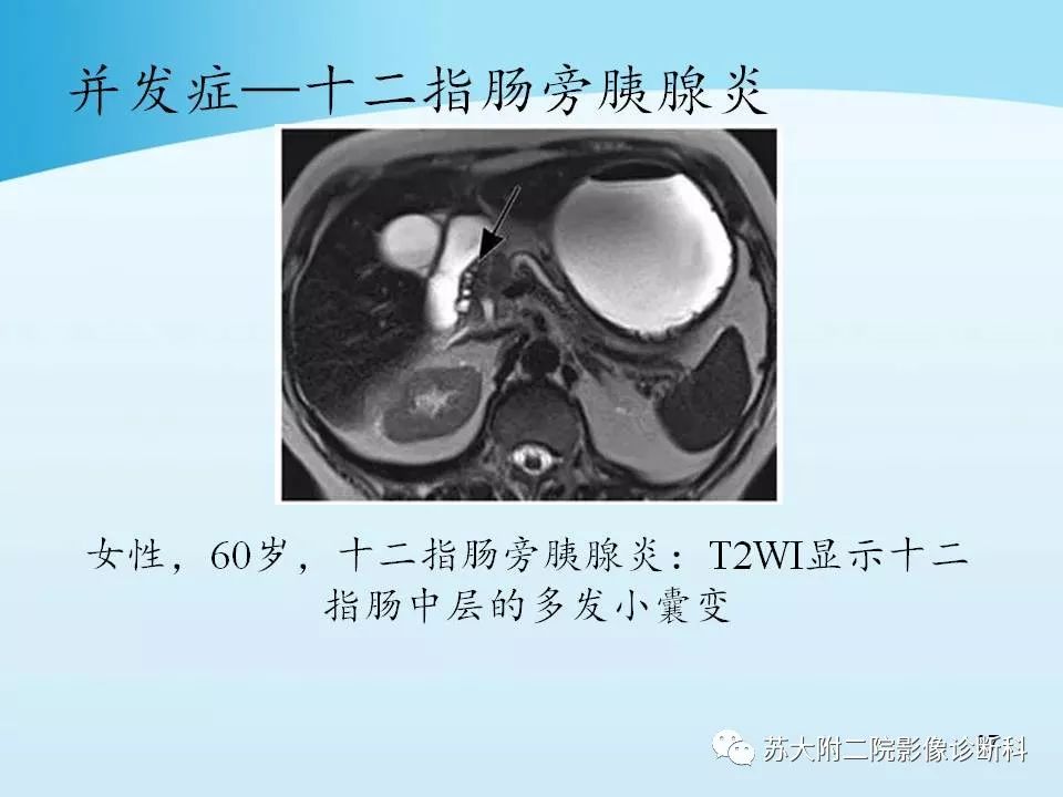 影像PPT - 【PPT】异位胰腺影像学特征及并发症-36