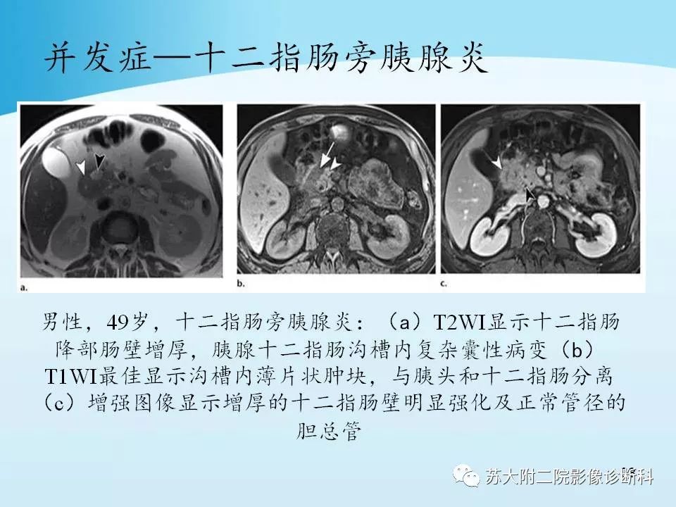 影像PPT - 【PPT】异位胰腺影像学特征及并发症-37