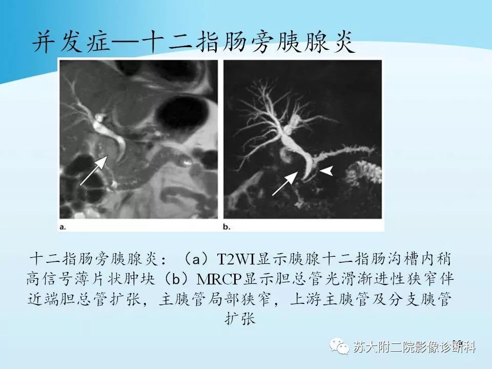 影像PPT - 【PPT】异位胰腺影像学特征及并发症-38