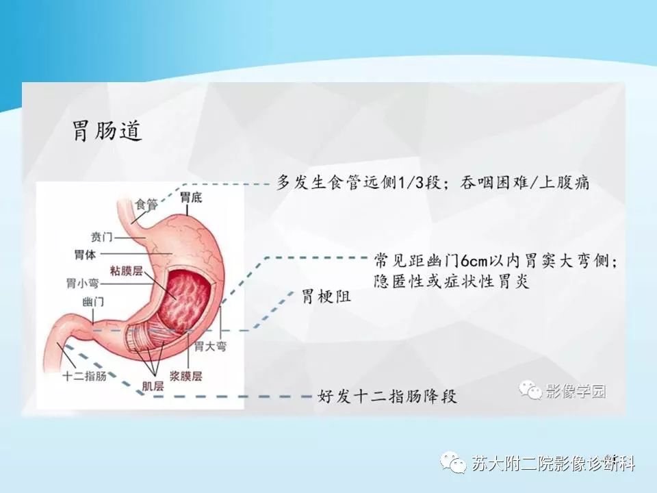 影像PPT - 【PPT】异位胰腺影像学特征及并发症-40