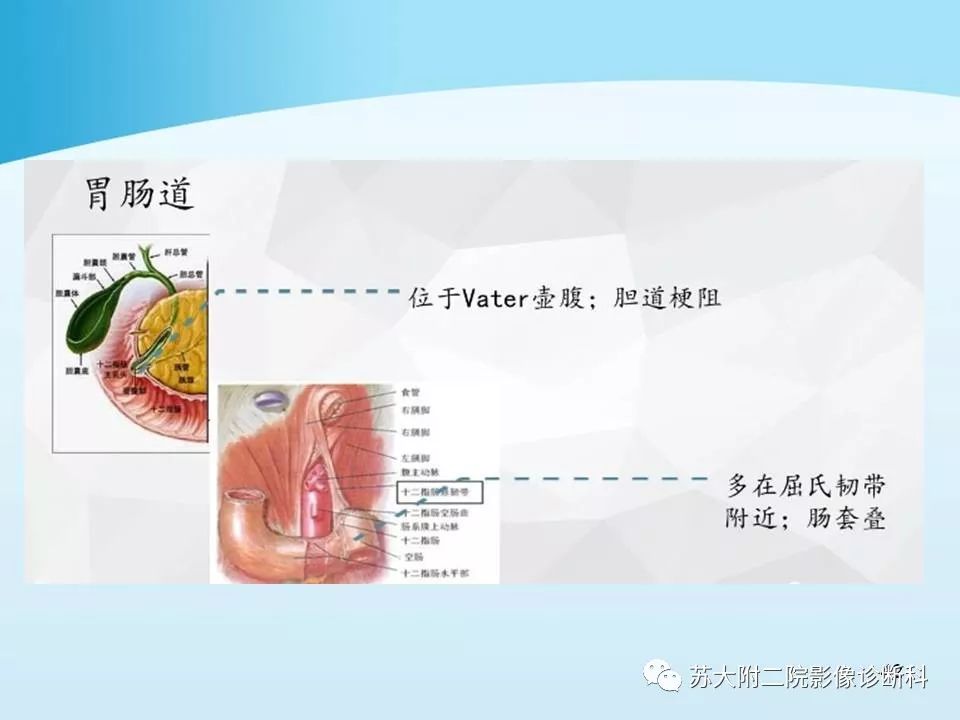 影像PPT - 【PPT】异位胰腺影像学特征及并发症-41