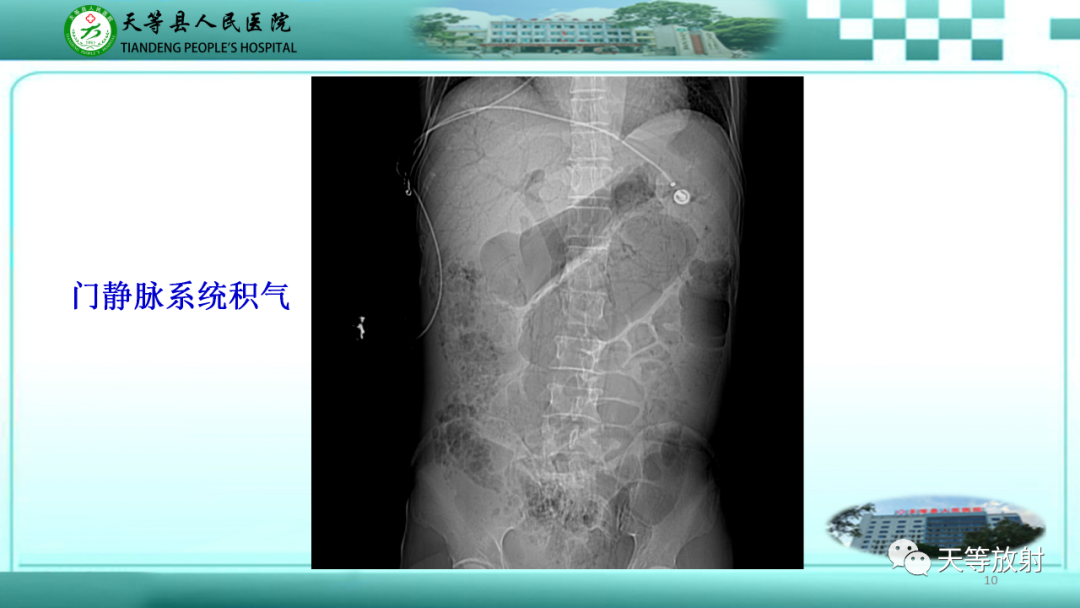 影像PPT - 【PPT】缺血性肠病的影像学表现-9