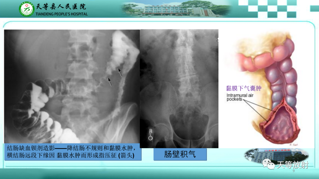 影像PPT - 【PPT】缺血性肠病的影像学表现-8